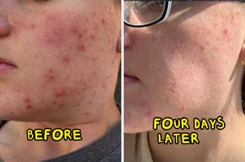 Before and after comparison of a person's cheek showing acne reduction over four days