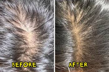 Before and after images of hair growth, showing reduced scalp visibility