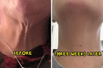 Split image showing a neck's transformation before and three weeks after using a skincare product, highlighting a smoother appearance