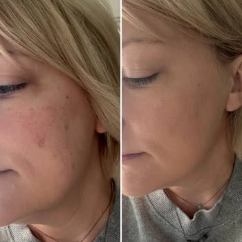 Side-by-side comparison of a woman's cheek before and after applying makeup foundation, showing reduced redness and smoother complexion