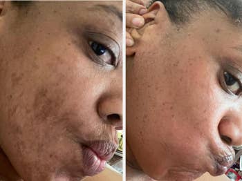 Two close-up selfies of a person's face showing visible skin improvement, highlighting a skincare product's effectiveness in reducing blemishes