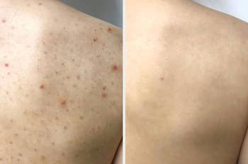 Before and after images of a person's back showing improvement in skin condition, relevant to skincare products