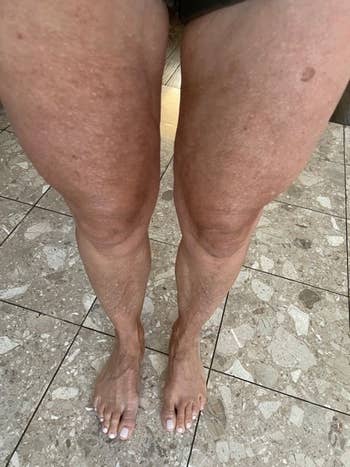 after photo of the same reviewer showing their leg skin is much tighter and the cellulite is basically gone